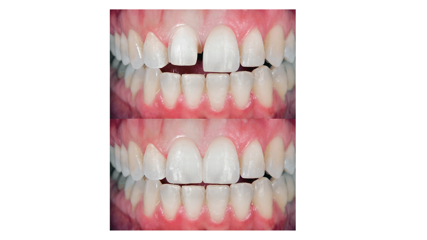 Before and after pictures of a tooth gap