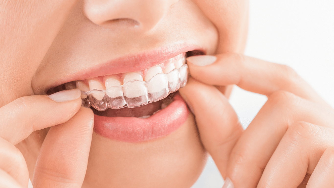 Woman inserting clear aligners onto teeth