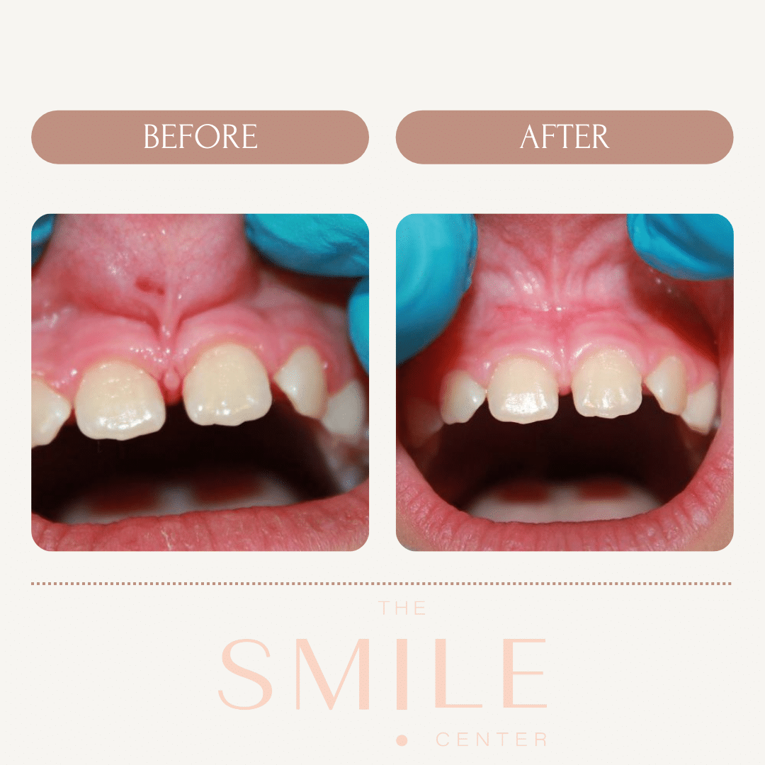Before and after photo of a lip tie treatment